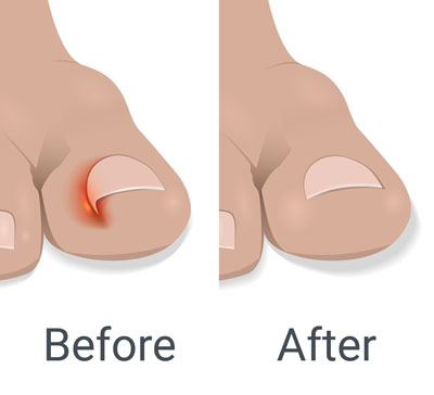 Ingrown toenail - Before and After