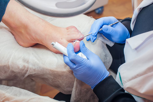 Nail surgery for ingrown toenails - Watson's Court Clinic